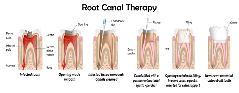 root-canal-dentist-upper-east-side