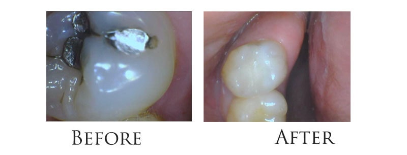 Composite Fillings Upper East Side 
