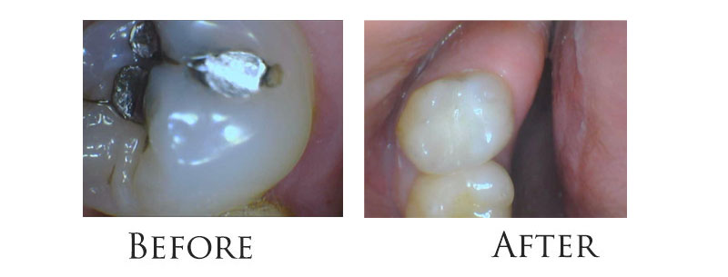 composite-fillings-upper-east-side