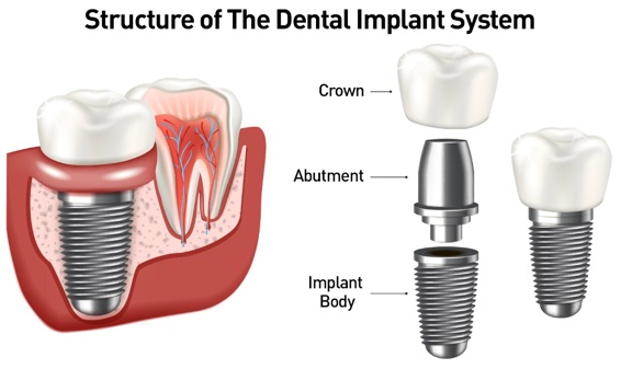 dental-implants-manhattan