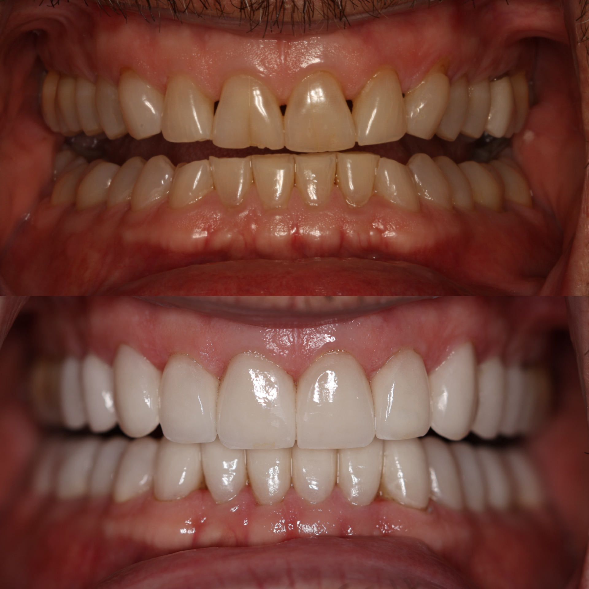 Porcelain Veneers Upper East Side