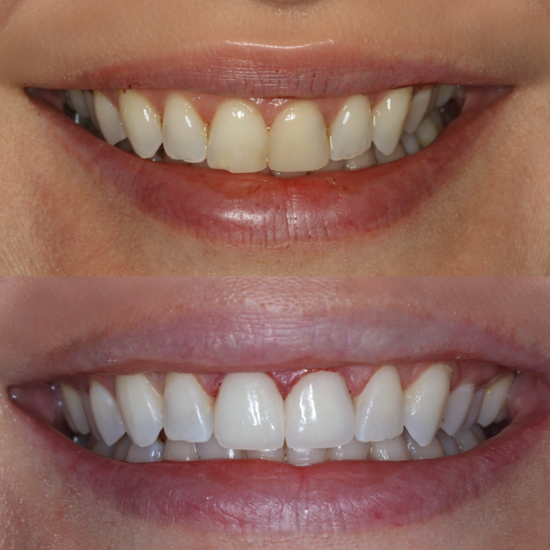 Porcelain Veneers Upper East side