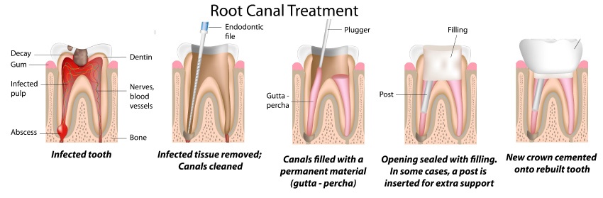 root-canal-upper-east-side