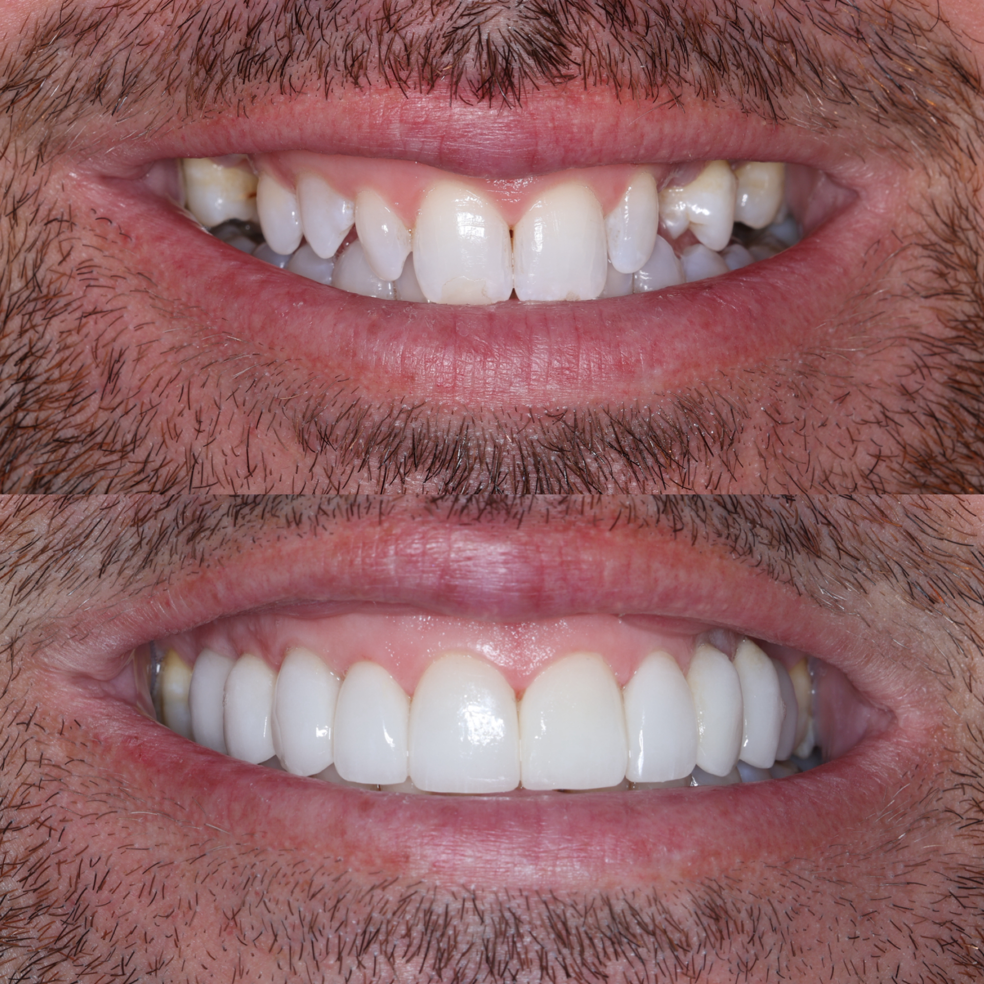 Veneers Before After Upper East Side